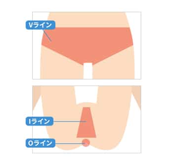 ミラクリニックVIO脱毛セット