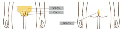 メンズキレイモのVIO脱毛の範囲（施術パーツ）を説明する画像