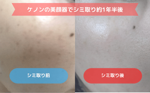 ケノンの美顔器の効果ビフォーアフター写真