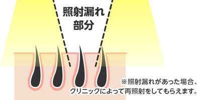 3.医療脱毛の施術時に照射漏れがあった