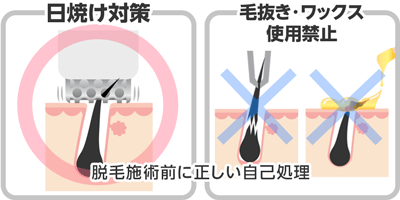 4.脱毛施術前に正しい自己処理をする