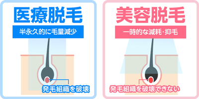 医療脱毛と美容脱毛の効果の違い【高い脱毛効果を期待するなら医療脱毛】