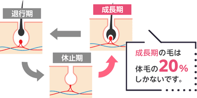 5.医療脱毛の施術時に休止期だったムダ毛が成長期に入った