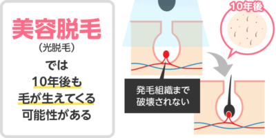 美容脱毛（光脱毛）では10年後も毛が生えてくる可能性がある