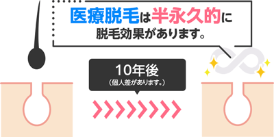 医療脱毛から10年後も永久脱毛効果を継続している人は多い