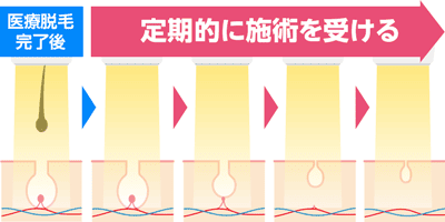 2.医療脱毛完了後も定期的に施術を受ける