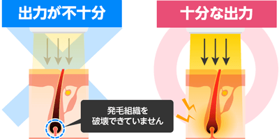 2.レーザー脱毛機の出力が不十分だった