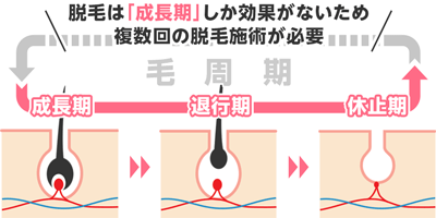 1.医療脱毛の施術が完了していない（回数が少なかった）