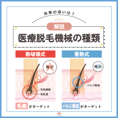 医療脱毛で使われる機械の種類【効果の違いを解説】