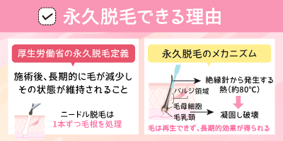 永久脱毛できる理由