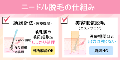 ニードル脱毛の仕組み（絶縁針法・美容電気脱毛）