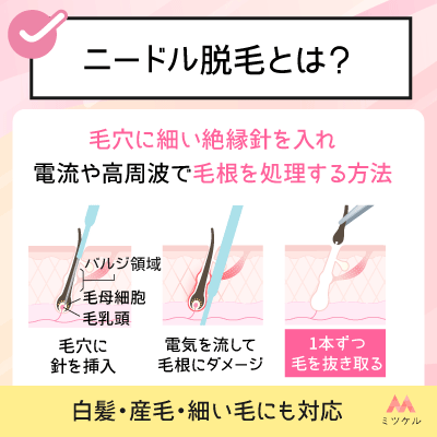 ニードル脱毛とは？特徴と他脱毛法との違い