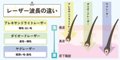 レーザー波長の違い【アレキ・ダイオード・ヤグ比較】
