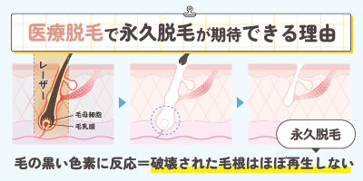 医療脱毛で永久脱毛が期待できる理由【医療レーザーの仕組み】