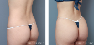 THE CLINIC_腹部・ボリュームアップのベイザー脂肪吸引の症例写真