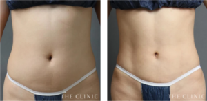 THE CLINIC_4D脂肪吸引の症例写真