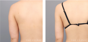 THE CLINIC_二の腕のベイザー脂肪吸引の症例写真